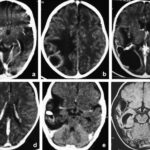 synergy for citrobacter meningitis