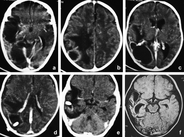 synergy for citrobacter meningitis