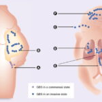 synergy for group b streptococcal septicemia