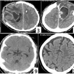 synergy for klebsiella meningitis