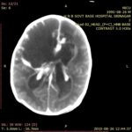 synergy for proteus meningitis