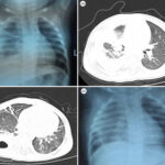 synergy for pseudomonas aeruginosa pneumonia