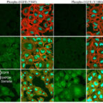synergy for serratia meningitis