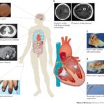 synergy for staphylococcal endocarditis
