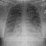 synergy for staphylococcus aureus pneumonia
