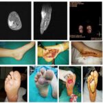 synovial sarcoma