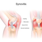 synovitis