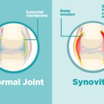 synovitis due to osteoarthritis