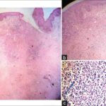 systemic anaplastic large cell lymphoma