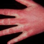 systemic dermatomyositis