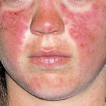 systemic lupus erythematosus