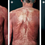 systemic mastocytosis