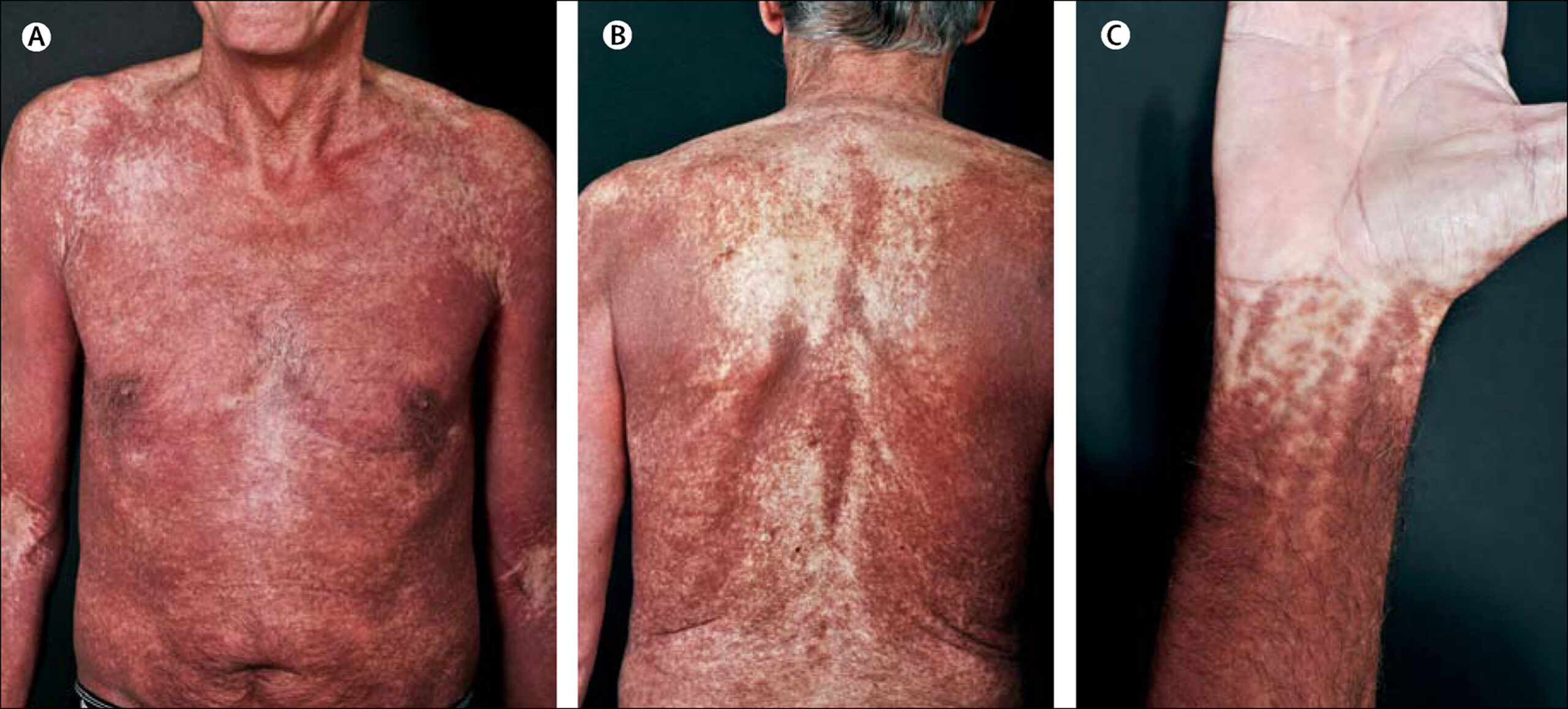 systemic mastocytosis