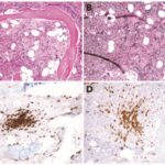 systemic mastocytosis with associated hematological neoplasm