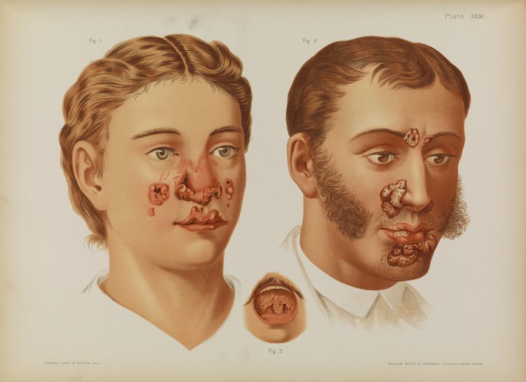 tertiary syphilis