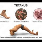 tetanus