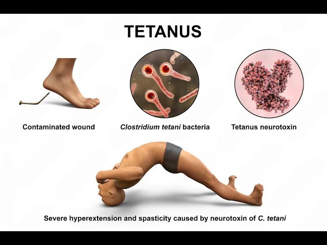 tetanus