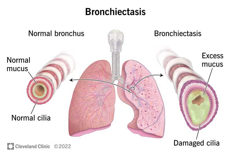 thick bronchial secretions