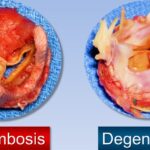 thromboembolism due to prosthetic heart valves