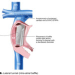 thrombosis prevention after fontan procedure