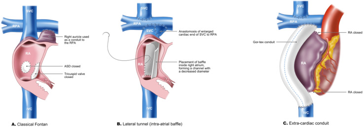 thrombosis prevention after fontan procedure