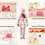 thrombosis with thrombocytopenia syndrome