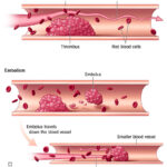 thrombotic disorder