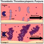 thrombotic thrombocytopenic purpura
