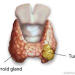 thyroid carcinoma