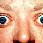 thyroid eye disease
