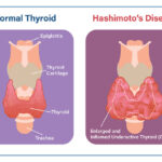 thyroiditis