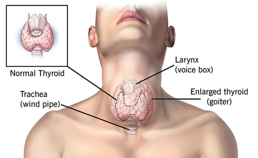 thyrotoxicosis