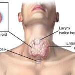 thyrotoxicosis