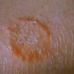 tinea corporis