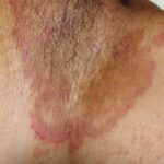 tinea cruris