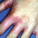 tinea manuum