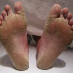 tinea pedis
