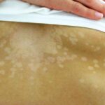 tinea versicolor