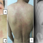 tnf receptor-associated periodic fever syndrome