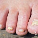 toenail onychomycosis