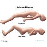 tonic-clonic epilepsy