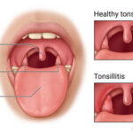tonsillitis