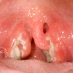 tonsillitis due to haemophilus influenzae