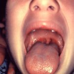tonsillitis due to streptococcus pyogenes