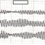torsades de pointes