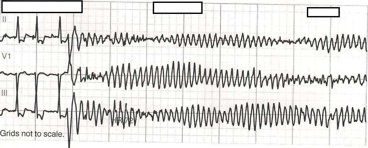 torsades de pointes