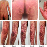 toxic epidermal necrolysis