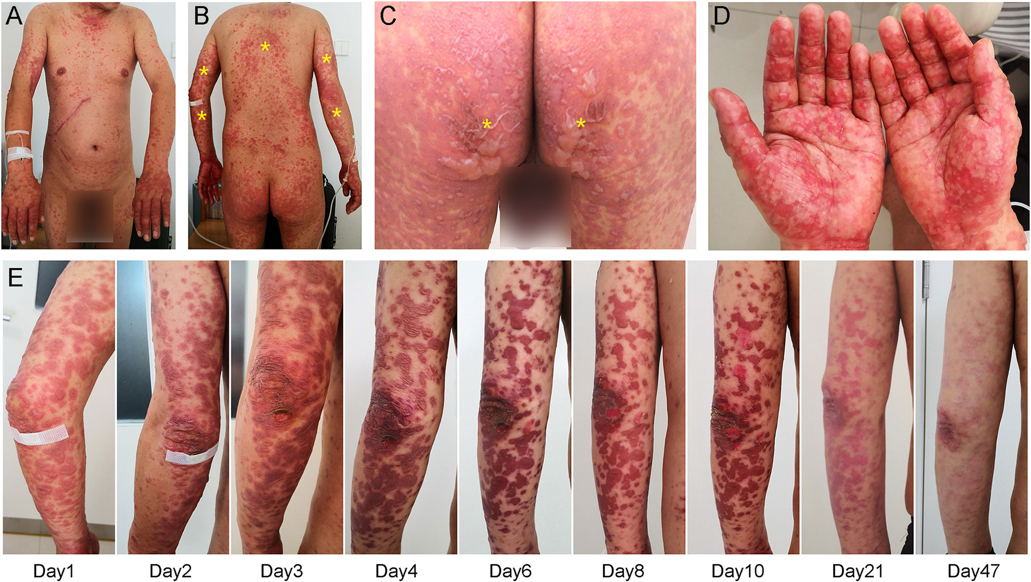 toxic epidermal necrolysis