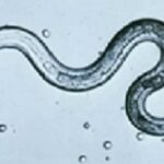 toxocariasis
