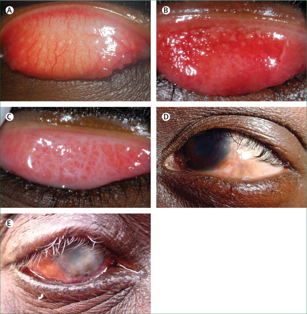 trachoma